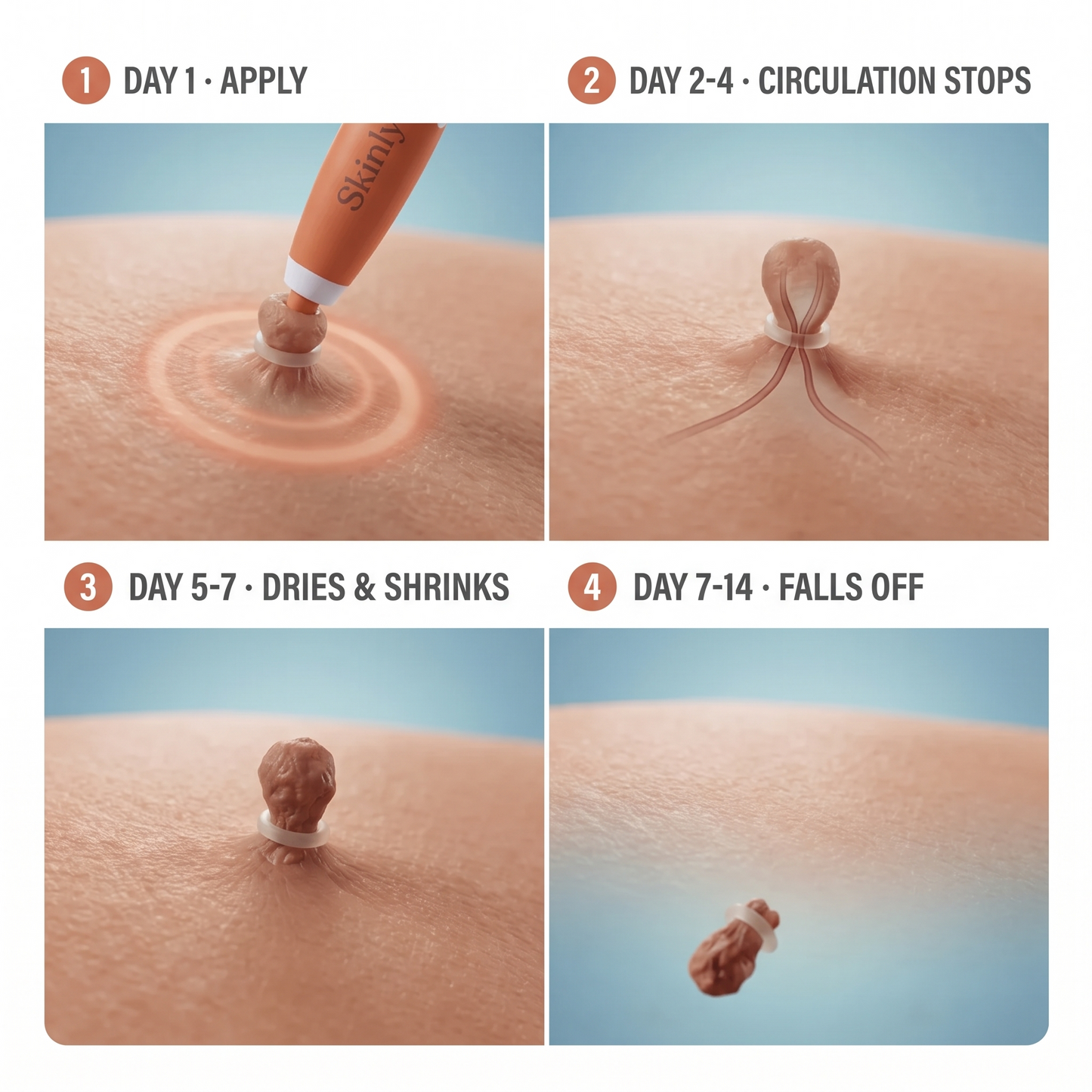 Skinly Skin Tag Removal Kit