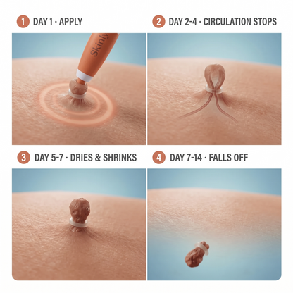 Skinly Skin Tag Removal Kit